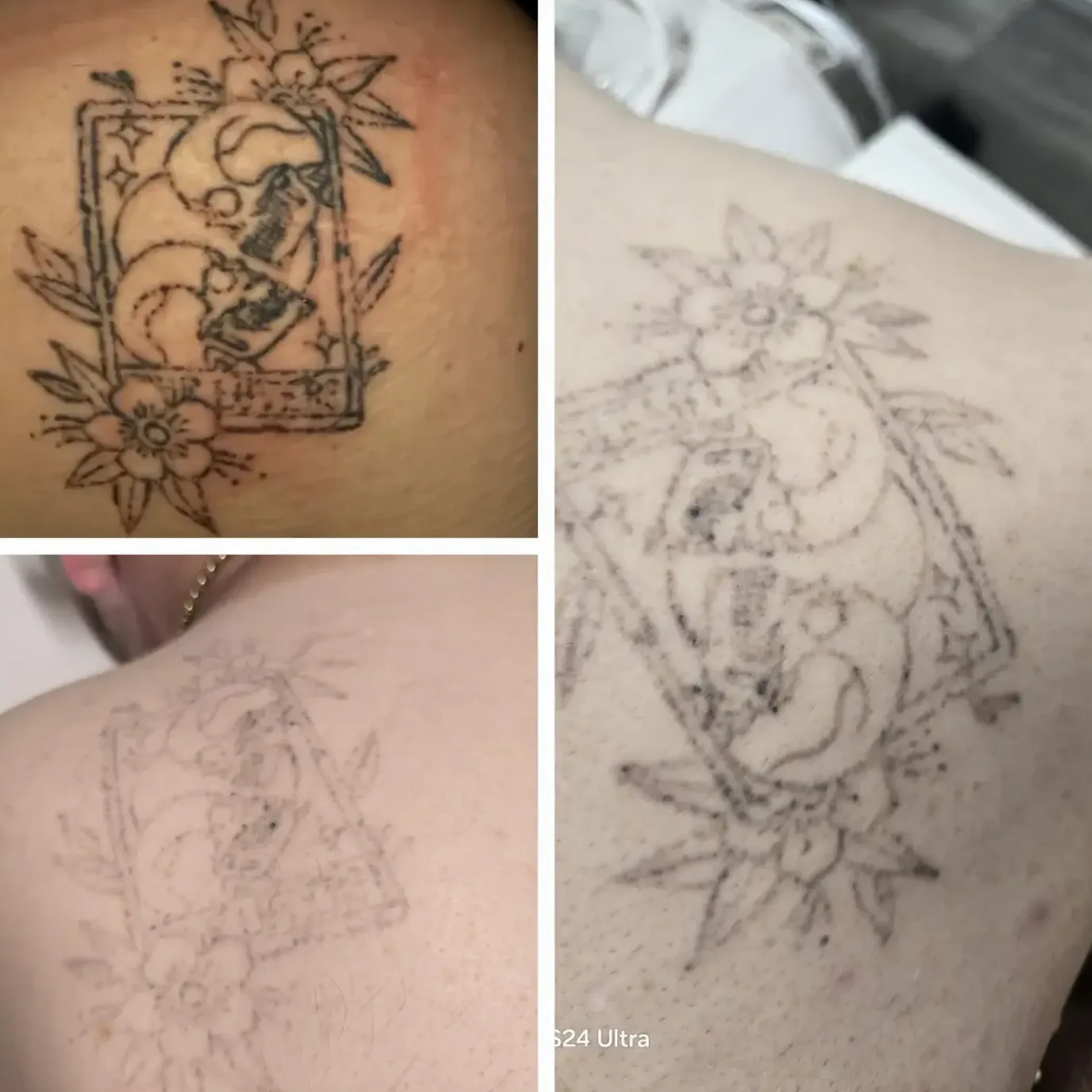 small blisters forming on tattoo removal site