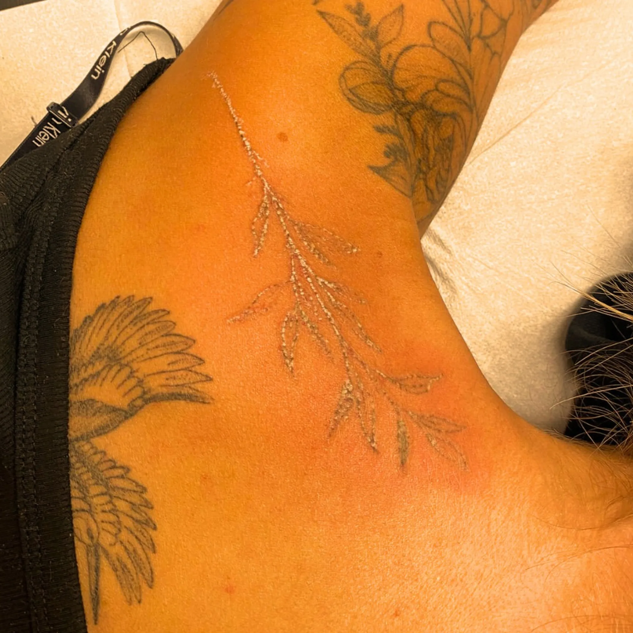 sterile dressing on ankle after tattoo removal