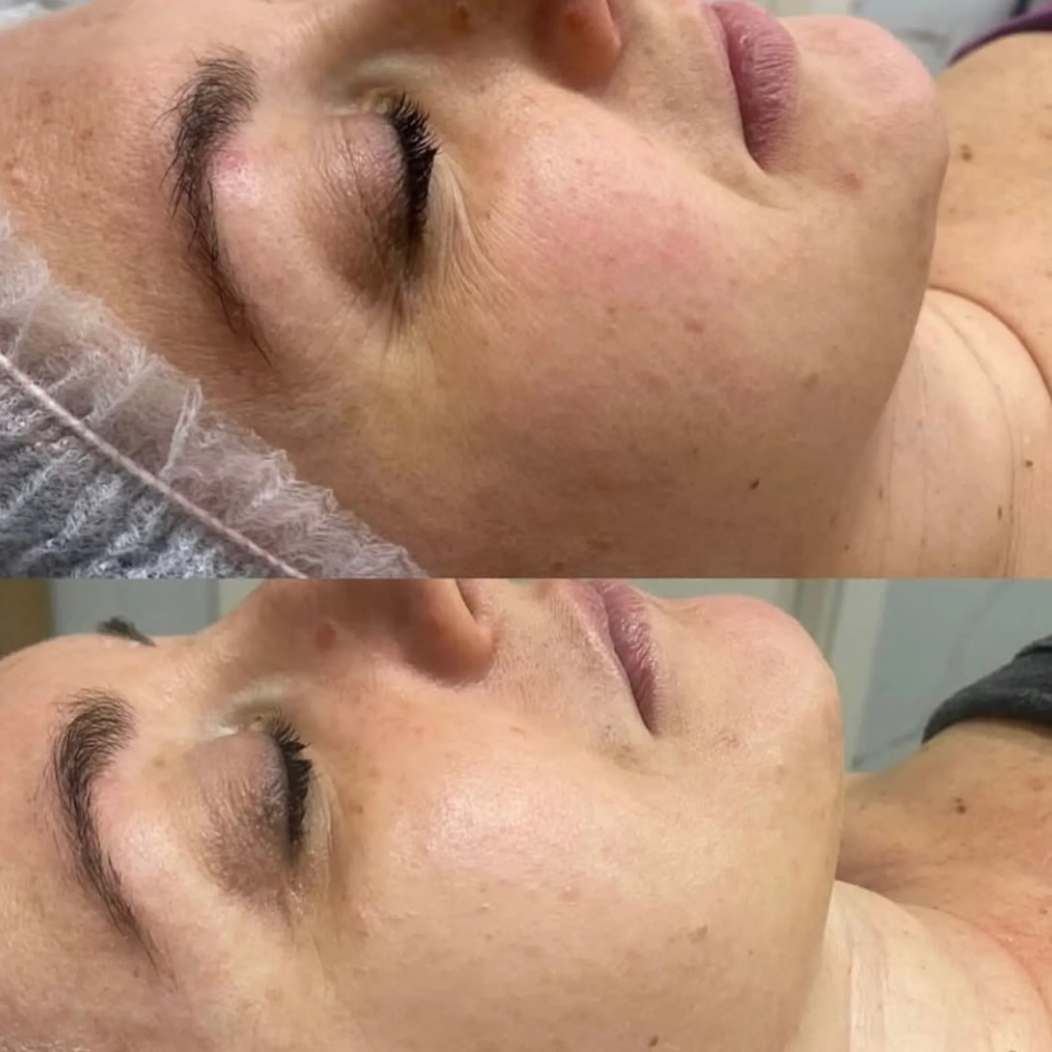 sensitive skin facial before and after